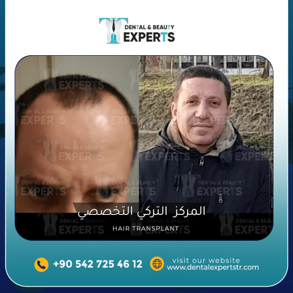 تجميل