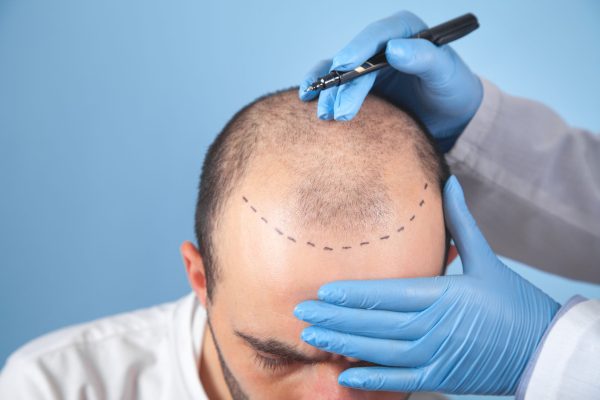 Patient suffering from hair loss in consultation with a doctor.